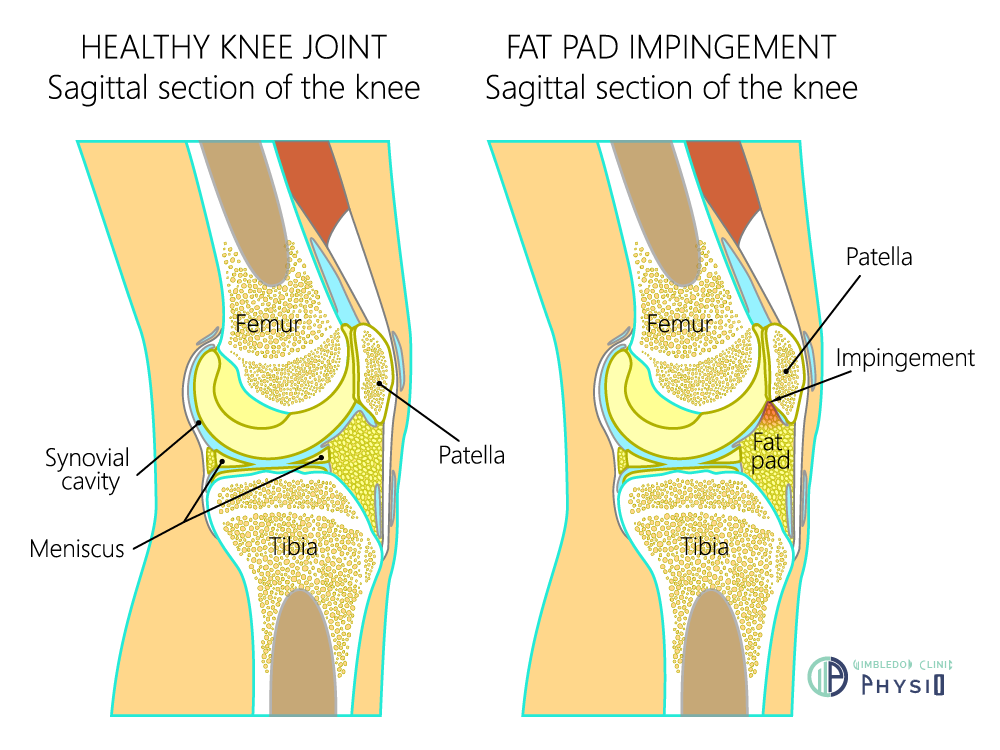Fat Pad Impingement Treatment Physio wimbledon